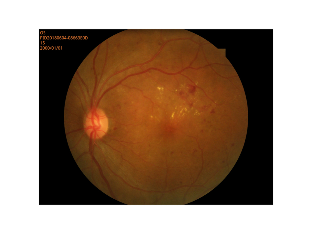 網膜イメージ投射 デジタルFundusのカメラの小さい生徒モード高リゾリューション